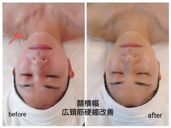 エステティック ブランシュール(Blancheur)/インディバフェイシャル９０分