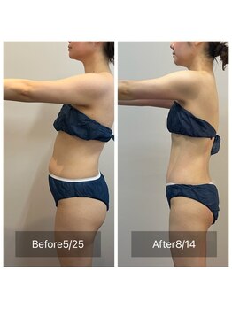 セレア(CELEA)/セル脂肪撃退／高周波で激痩