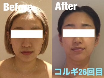 ビーキュート 渋谷北参道店(BE-CUTE)/小顔コルギ26回目 20代