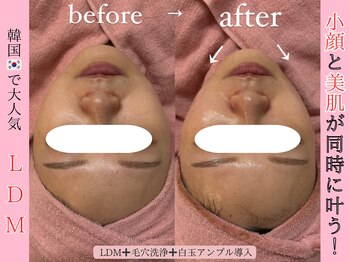 エンクリニカルラボ 三宮店(E&N CLINICAL LABO)/LDMパッケージ/美肌・小顔W照射