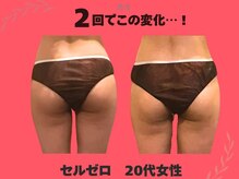 美方/下半身セルゼロ体験