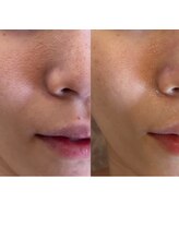 アンク(Ankh)/意外と気なる鼻筋の毛穴