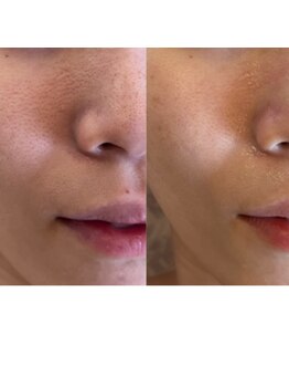 アンク(Ankh)/意外と気なる鼻筋の毛穴