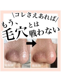 ルネッタ(Lunetta)/