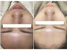 モンクラッシー(Mon classy)/水光ピールビフォーアフター