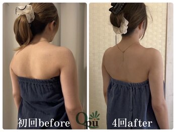 キュープ 福岡天神店(Qpu)/巻き肩コース4回での変化