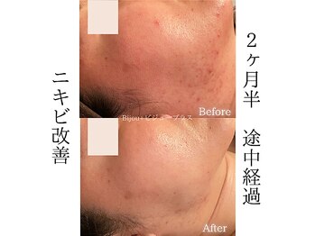 ビジュープラス 水戸店(Bijou+)/ホルモン影響/ニキビケア