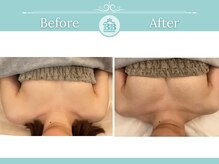 美人バスト 福岡店/バストアップ ◇症例◇