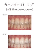 プライムデュオ(Prime Duo)/20分×3回照射 beforeafter