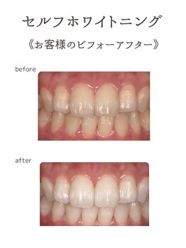 プライムデュオ(Prime Duo)/20分×3回照射 beforeafter