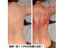 マーズ(Mars)/脂肪セル撃退