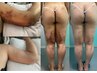 《都度払いインディバ術後ケア》背中/腰/太もも/二の腕など指定部位集中 90分