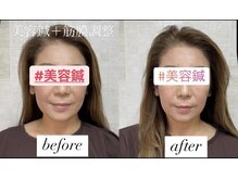 ヤマモト 表参道院(YAMAMOTO)/美容鍼　＋筋膜調整(手技)