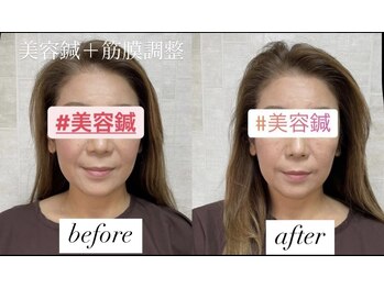 ヤマモト 表参道院(YAMAMOTO)/美容鍼　＋筋膜調整(手技)