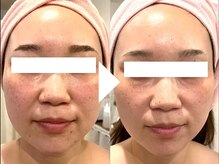 ビースト 下北沢店(B-st.)/フェイシャル｜全顔3回