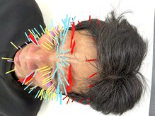 とだ鍼灸院/《額/眉間のシワ美容鍼150本◎》