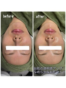 クラリ(Clari)/毛穴/ハイドラ/毛穴洗浄