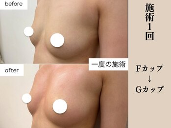 ソワ(soie)/ハリのある上向きバスト