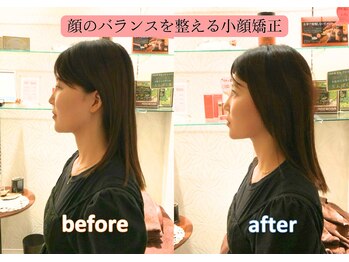 おかもと鍼灸整骨院/顔のバランスを整える小顔矯正