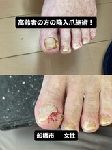 巻き爪じゅん 船橋店/高齢者巻き爪陥入爪の痛み改善