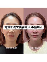 ハリサク/継続施術