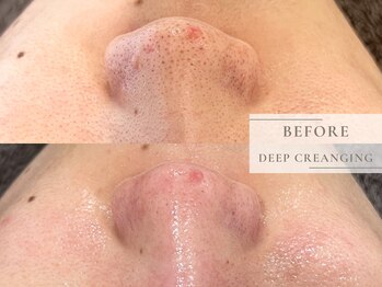 レヴィア(Revia)/毛穴の黒ずみにも