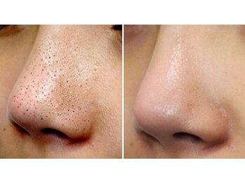 ビューティサロン レーヴ(Reve)の写真/毛穴ケアでクリアなお肌へ☆シミシワ改善でスッピン美人を目指しませんか？