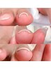 巻き爪矯正 1本3300円