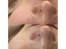 ノイ(Noi.)/Before-After