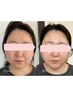 速効性.小顔になりたい【むくみ・エラ・二重あご・たるみ改善】通常¥11000