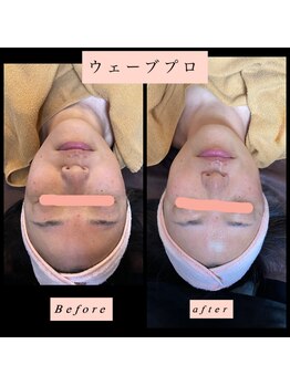 ティアメディカル(Tia Medical)/HIRFWAVEPro