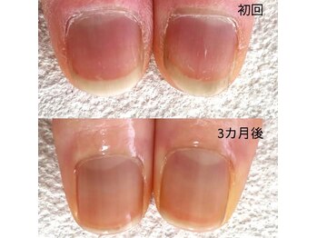 たった3か月！縦長美爪に