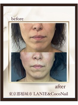 ラニー アンド ココネイル(LANIE&CocoNail)/大人肌のお悩みに！Lit(リット)