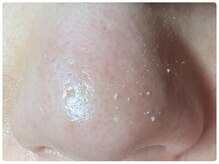 カピリナ(ka pilina)/皮脂にょろ毛穴ケアでサヨナラ～