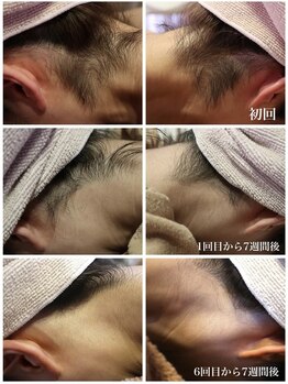 ベビースキン(baby skin)/えり足脱毛