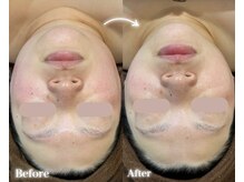 エステティック レイビス 八戸店(RAYVIS)/美白・小顔になりたい方に！