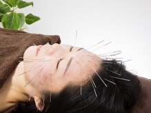 アイリス鍼灸マッサージ 上野院(Iris鍼灸マッサージ)の雰囲気（特注の鍼で鬼美容鍼。）