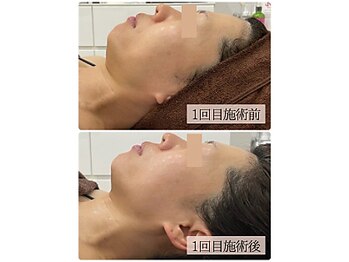 リノン(LINON)/ハーブピーリング 施術回数1回