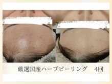 ソウナ(SONA)/厳選国産ハーブピーリング4回