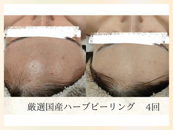 ソウナ(SONA)/厳選国産ハーブピーリング4回