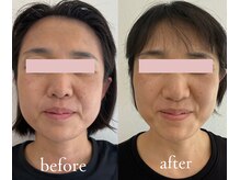 トリートメントルーム フェリーチェ(Felice)/NO糸リフト！下顔面がスッキリ