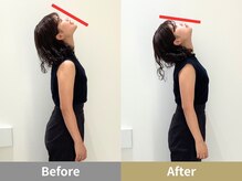 せなかのはね 井尻店/20代女性　ストレートネック