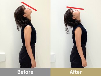 せなかのはね 井尻店/20代女性　ストレートネック