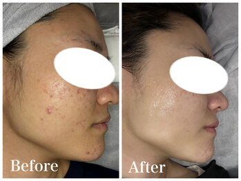 ノア 新宿(Noa)/ハーブピーリング＋マシン 6回