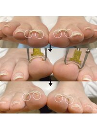 巻き　爪　緩和ケア