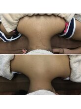 ウルル 栄店(ULULU)/背中脱毛♪