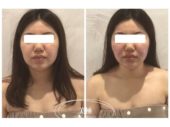 美極 銀座店/銀座/小顔コルギ/小顔矯正