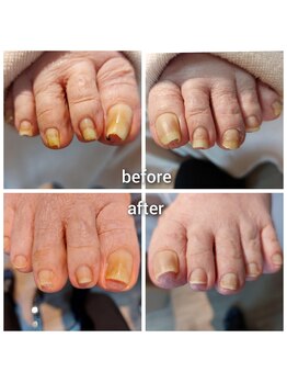 爪切り屋 足楽/2か月毎のケア◆ご高齢者爪切り