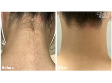 ロカビリー(Rockabilly)/レディース　襟足脱毛