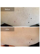 ビビ(VIVI)/背中ニキビケアハーブピーリング